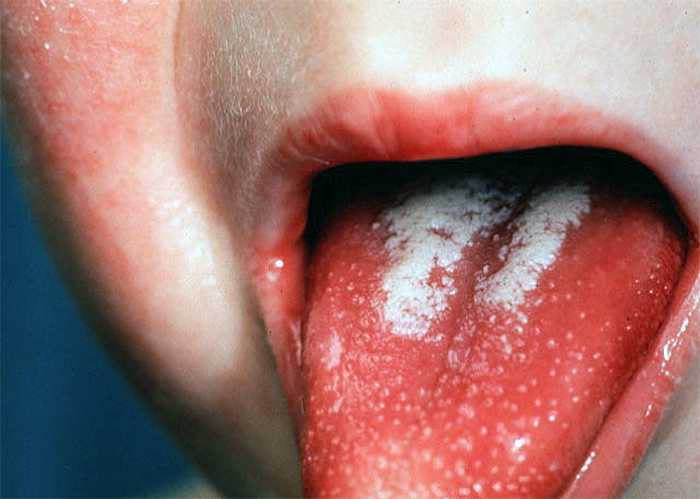 Санепідситуація в Ірпені: гепатит і скарлатина