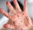 Лікарі підтвердили захворювання на кір у Приірпінні в 7 дорослих та 4 дітей (+ відео)