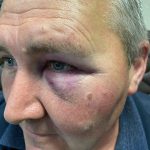 Струс мозку та інші травми – передвиборче побиття в Горенці (+ фото, відео)